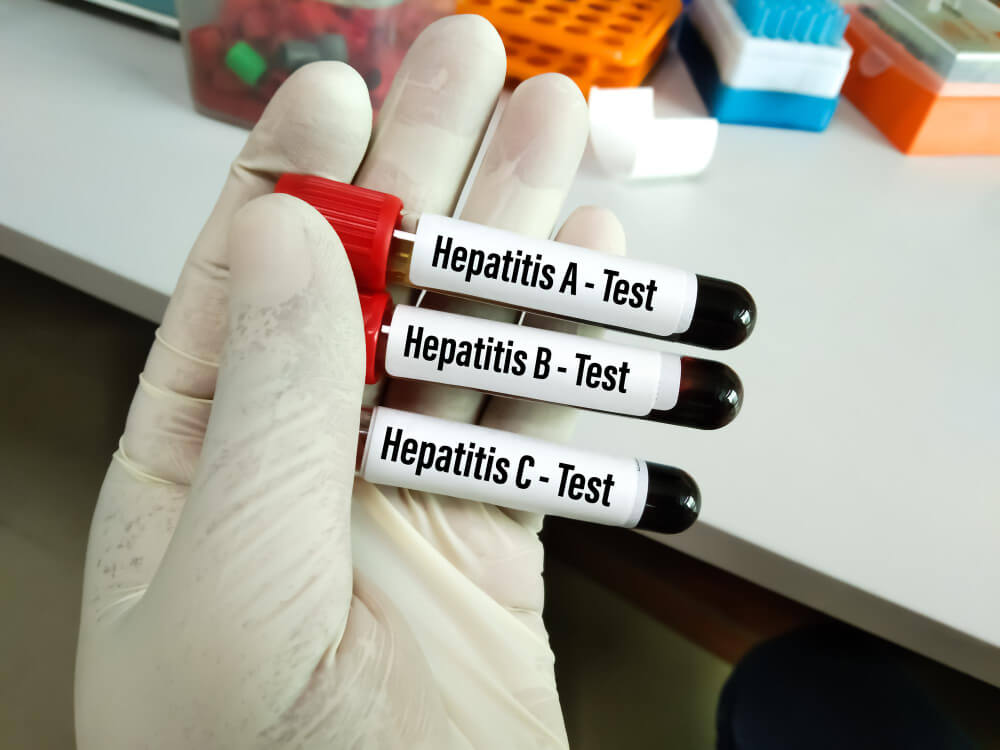 hepatit c xəstəliyi