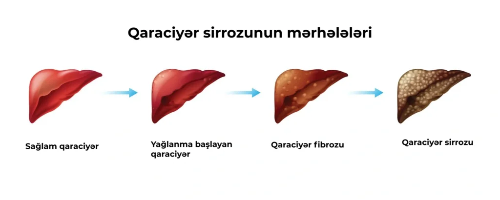 qaraciyər sirrozu